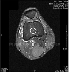 MRI axial projections. Pulsation artifacts are visible extending  in a horizontal line from the blood vessel (marked by circles)
