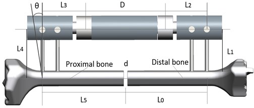 The physical model of fixator-bone system. L0=L5= 83 mm; L2=L3= 40 mm;  D= 90 mm; d= 4 mm, L4= 60 mm, θ= 0-30°