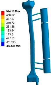 Stress distribution of fixator-bone system without pin deviation under axial, torsional and bending load: a) stress distribution of fixator-bone system without pin deviations under axial load,  b) stress distribution of fixator-bone system without pin deviations under torsional load,  c) stress distribution of fixator-bone system without pin deviations under bending load