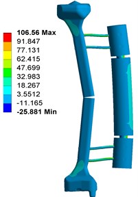 Stress distribution of fixator-bone system without pin deviation under axial, torsional and bending load: a) stress distribution of fixator-bone system without pin deviations under axial load,  b) stress distribution of fixator-bone system without pin deviations under torsional load,  c) stress distribution of fixator-bone system without pin deviations under bending load