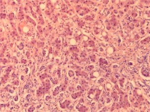 Images of liver tissue with plethora, dystrophy, cirrhosis and metastasis