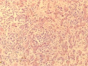Images of liver tissue with plethora, dystrophy, cirrhosis and metastasis