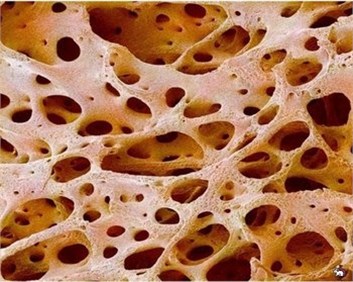 Images of healthy bone tissue and bone tissue with osteoporosis
