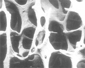 Images of healthy bone tissue and bone tissue with osteoporosis