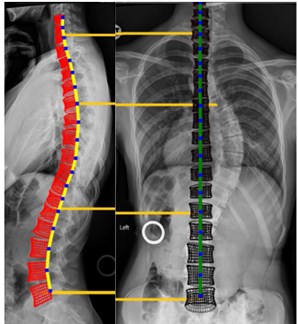 A preview of the software that allows to change the spine geometry: a) Non-scoliotic spine, b) scoliotic spine
