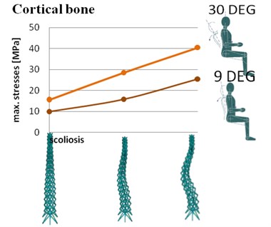 Maximum stresses in spine with different configurations of geometry in cortical bone