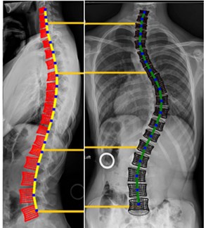 A preview of the software that allows to change the spine geometry: a) Non-scoliotic spine, b) scoliotic spine