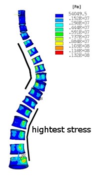 Equivalent von Misses stress distribution in: a)-b) no scoliotic spine, a) cortical bone, b) cancellous bone, c)-d) scoliotic spine, c) cortical bone, d) cancellous bone
