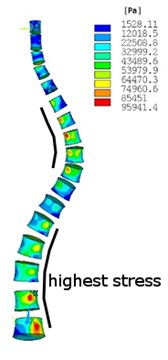 Equivalent von Misses stress distribution in: a)-b) no scoliotic spine, a) cortical bone, b) cancellous bone, c)-d) scoliotic spine, c) cortical bone, d) cancellous bone