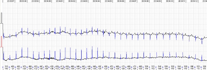 QRS morphology and voltage shift