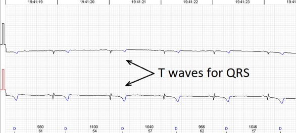 Errors of the automated analysis leading to false arrhytmia or heart rate variability parameter calculations if not corrected manually. a) Demonstrates a case of rather low wave amplitudes leading to relatively ‘deep’ T wave being considered as a QRS complex, marked as ‘D’ (defined event);  b) shows a case of a single unidentified QRS complex and several T waves marked  as ventricular extrasystole (VEx), marked as ‘V’ (ventricular event); c) a combination  of errors where normal QRS complexes are defined as VEx and T waves defined as QRS;  d) software failed to detect a sequence of several low amplitude QRS complexes