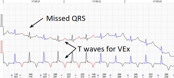 Errors of the automated analysis leading to false arrhytmia or heart rate variability parameter calculations if not corrected manually. a) Demonstrates a case of rather low wave amplitudes leading to relatively ‘deep’ T wave being considered as a QRS complex, marked as ‘D’ (defined event);  b) shows a case of a single unidentified QRS complex and several T waves marked  as ventricular extrasystole (VEx), marked as ‘V’ (ventricular event); c) a combination  of errors where normal QRS complexes are defined as VEx and T waves defined as QRS;  d) software failed to detect a sequence of several low amplitude QRS complexes