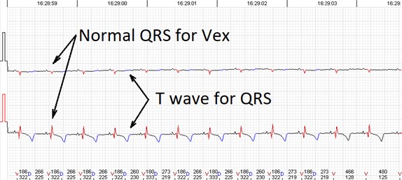 Errors of the automated analysis leading to false arrhytmia or heart rate variability parameter calculations if not corrected manually. a) Demonstrates a case of rather low wave amplitudes leading to relatively ‘deep’ T wave being considered as a QRS complex, marked as ‘D’ (defined event);  b) shows a case of a single unidentified QRS complex and several T waves marked  as ventricular extrasystole (VEx), marked as ‘V’ (ventricular event); c) a combination  of errors where normal QRS complexes are defined as VEx and T waves defined as QRS;  d) software failed to detect a sequence of several low amplitude QRS complexes