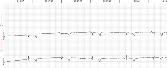 Errors of the automated analysis leading to false arrhytmia or heart rate variability parameter calculations if not corrected manually. a) Demonstrates a case of rather low wave amplitudes leading to relatively ‘deep’ T wave being considered as a QRS complex, marked as ‘D’ (defined event);  b) shows a case of a single unidentified QRS complex and several T waves marked  as ventricular extrasystole (VEx), marked as ‘V’ (ventricular event); c) a combination  of errors where normal QRS complexes are defined as VEx and T waves defined as QRS;  d) software failed to detect a sequence of several low amplitude QRS complexes