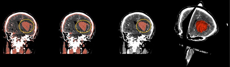 (From left to right) The hematoma in the yellow circle is what we want to separate, using thresholding in the above order, then using smoothing to optimize staining, and finally using Islands to separate the hematoma. On the far right is the fusion of the hematoma and the three-dimensional map