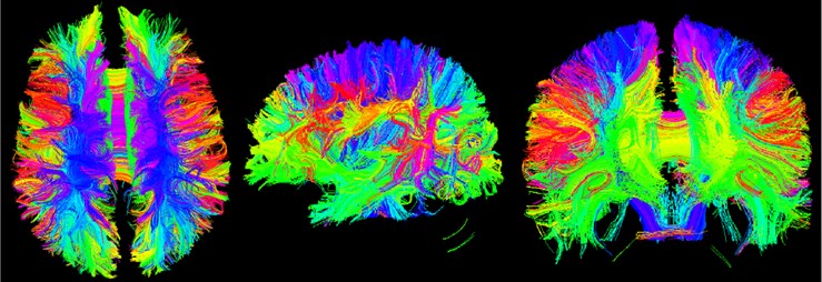 Three-bit imaging of brain fiber bundles