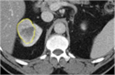 The tumor in the right kidney which had the PBRM1 mutation is indicated by the yellow contour