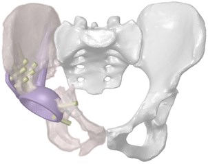 Three-dimensional model of the restored hip joint system