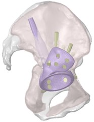 Three-dimensional model of the restored hip joint system