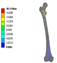 Total deformation in: a) coxa valga, b) coxa norma, c) coxa vara in 3D model static analysis