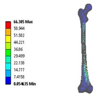 Vonmises stress distribution: a) coxa valga, b) coxa norma, c) coxa vara  in 3D model static analysis