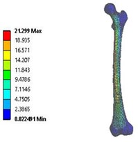 Vonmises stress distribution: a) coxa valga, b) coxa norma, c) coxa vara  in 3D model static analysis