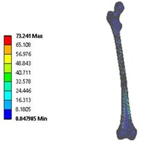 Vonmises stress distribution: a) coxa valga, b) coxa norma, c) coxa vara  in 3D model static analysis