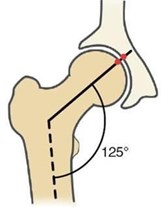 Caput collum diaphysis deformity based on FSA [3]