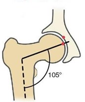 Caput collum diaphysis deformity based on FSA [3]