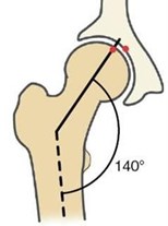 Caput collum diaphysis deformity based on FSA [3]