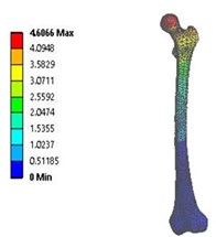 Total deformation in: a) coxa valga, b) coxa norma, c) coxa vara in 3D model static analysis