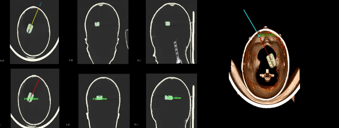 Spee-D-Mark CT Scan Skin Markers