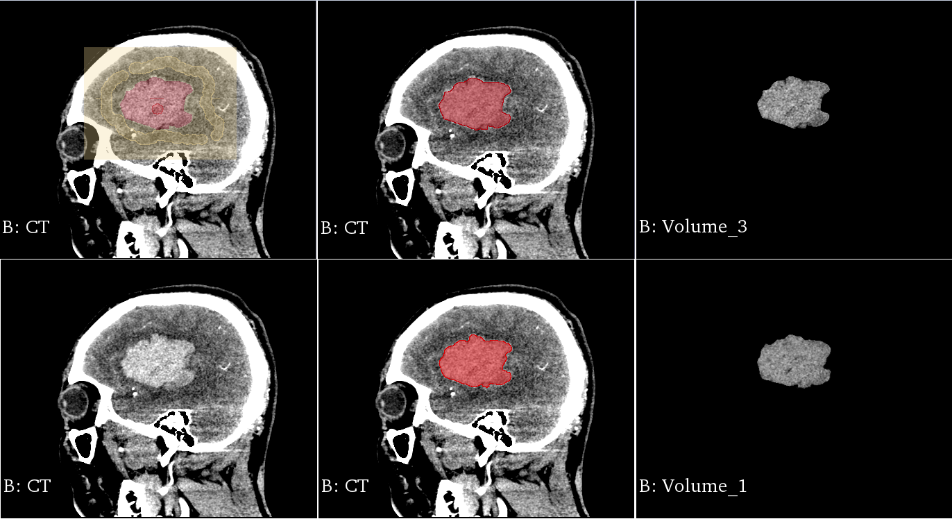 Brain CT image segmentation based on 3D slicer