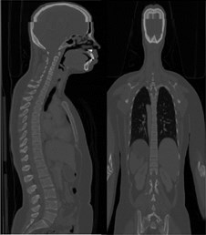 a) CT scan in DICOM format, b) Segmentation in MIMICS 21.0, c) Accurate surfaces in 3-Matic