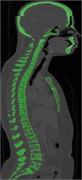 a) CT scan in DICOM format, b) Segmentation in MIMICS 21.0, c) Accurate surfaces in 3-Matic