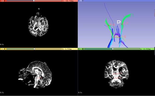 Modeling of corticospinal tract