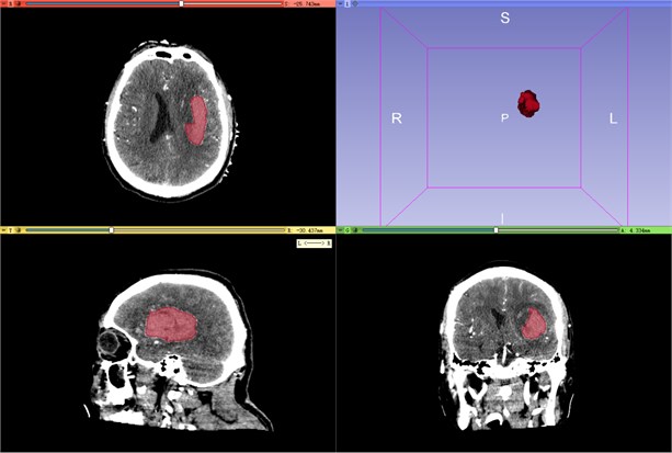 Hematoma modeling demonstration