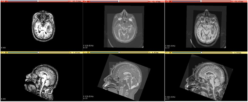 From left to right, Mr, DTI and CT, DTI and Mr registration effect