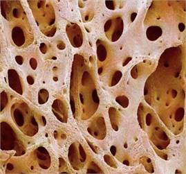a) Healthy bone, b) osteoporosis