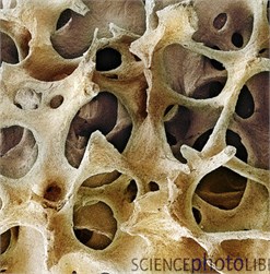 a) Healthy bone, b) osteoporosis