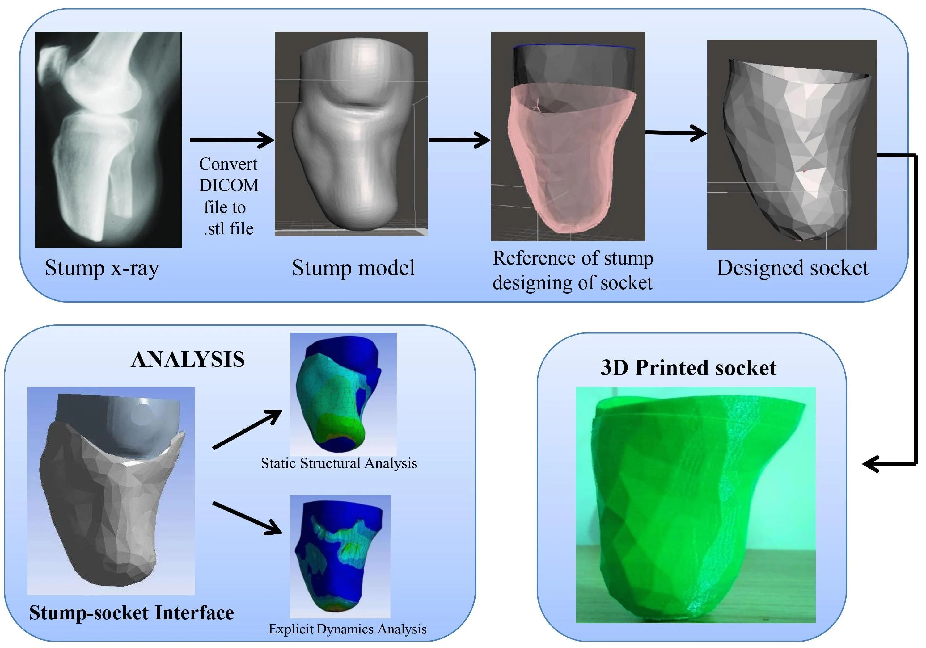 Design and development of patient-specific prosthetic socket for lower limb amputation