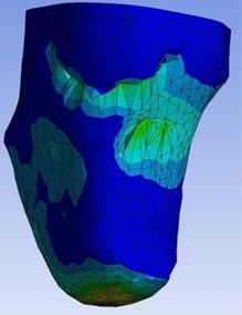 Total deformation of the stump-socket interface