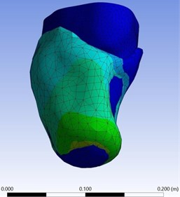 Total deformation of the stump-socket interface