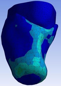 Von-Mises stress of the stump-socket interface