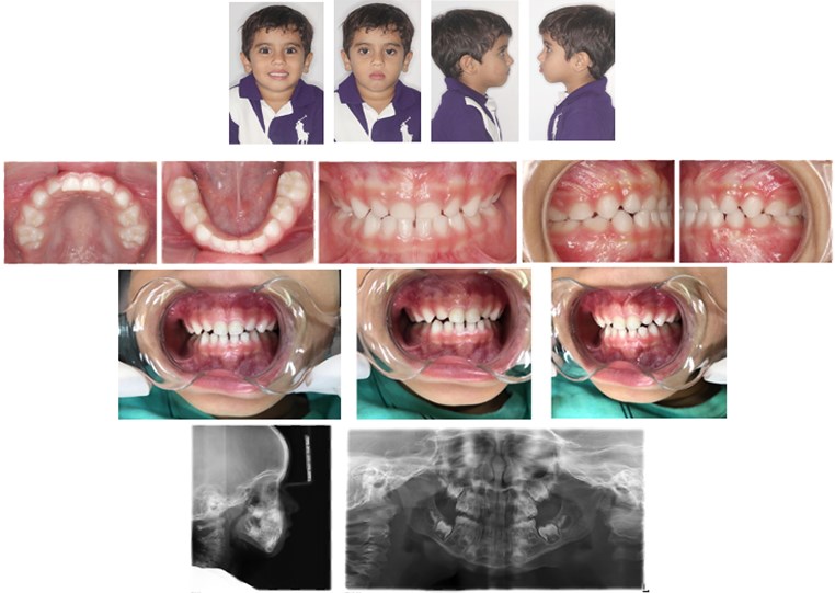 First line: face photographs; Second and third line: intraoral photographs;  fourth line: panoramic radiograph and teleradiograph