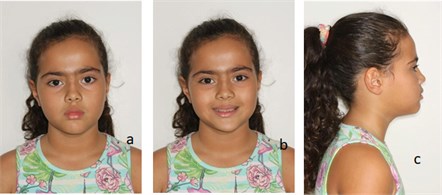 Patient’s registries in 2016. Pictures were taken after the use of SN3 with Eschler’s arch.  Face photographs: a) frontal profile; b) frontal profile – smile; c) right profile; d) left profile; e) teleradiograph; f) intraoral – right profile; g) intraoral – occlusion; and h) intraoral – left profile