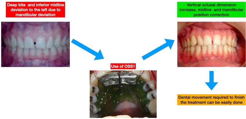 Functional orthopedic appliance for vertical dimension increase and mandibular deprogramming ORLANDO SANTIAGO SYSTEM 1 – OSS1. Indications and laboratorial manufacturing