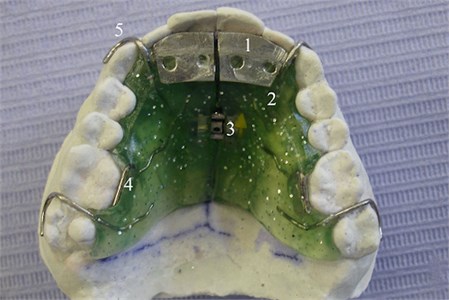 Oclusal view of OSS1 in the cast. 1) equiplan; 2) acrylic; 3 expander screw;  4) resort in “S”; 5) retention clamp