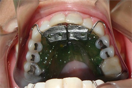 OSS1 in mouth. Above the equiplan, Bimler’s frontal resort can be seen. Resorts in “S”  can be seen touching 16 and 26. Retention clamps placed on tooth 17 and 27