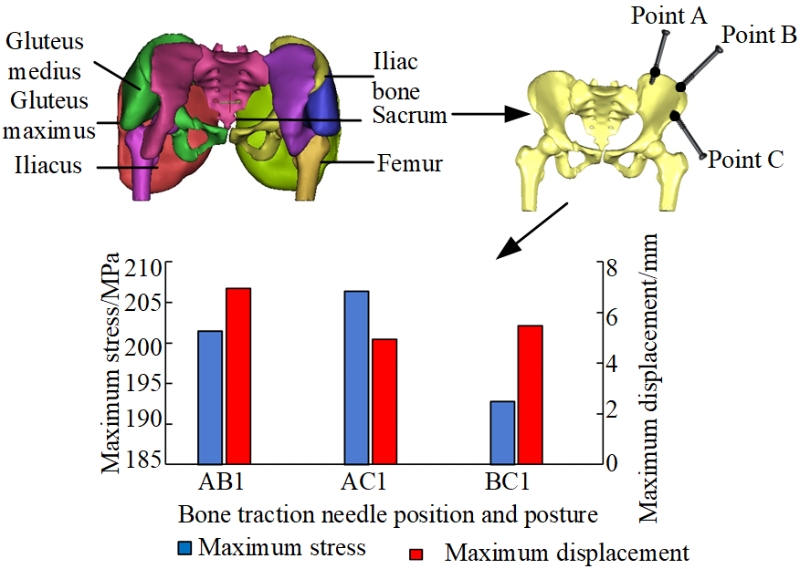 Analysis on circumpelvic muscle force and spatial position and orientation of bone traction needle for pelvic fracture reduction